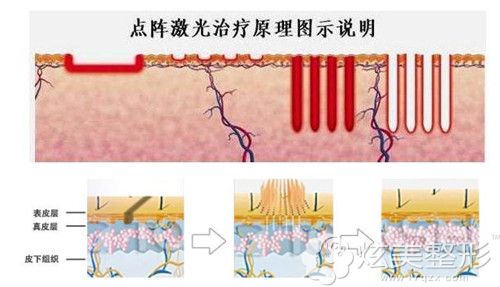 东莞华美CO2点阵激光治疗 东莞华美CO2点阵激光治疗