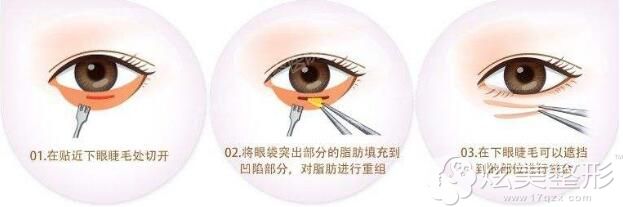 长沙爱思特去眼袋手术方法 长沙爱思特去眼袋手术方法