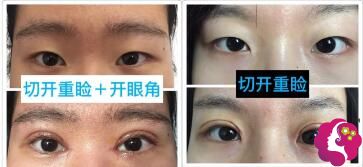 于清国医生眼部整形案例 于清国医生眼部整形案例