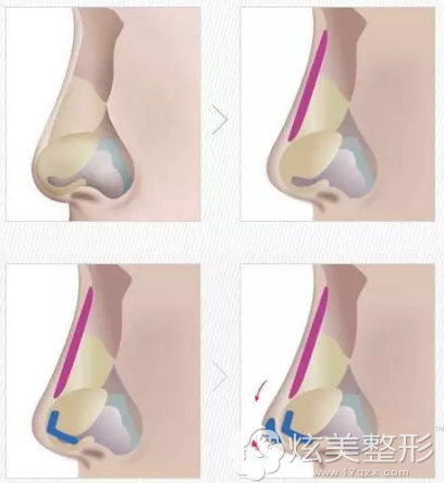 欧式小翘鼻原理 欧式小翘鼻原理