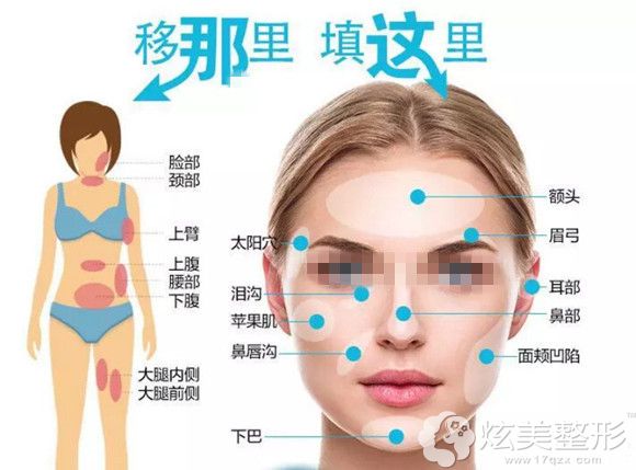 万家燕鸿源医院整形自体脂肪填充示意图