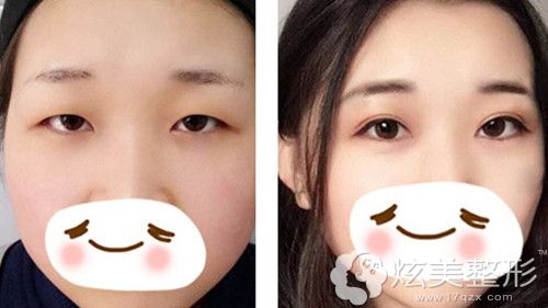 谭成林院长双眼皮案例 谭成林院长双眼皮案例
