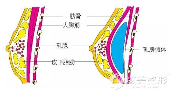 假体隆胸原理 假体隆胸原理