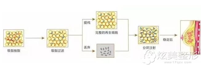 自体脂肪隆胸原理 自体脂肪隆胸原理