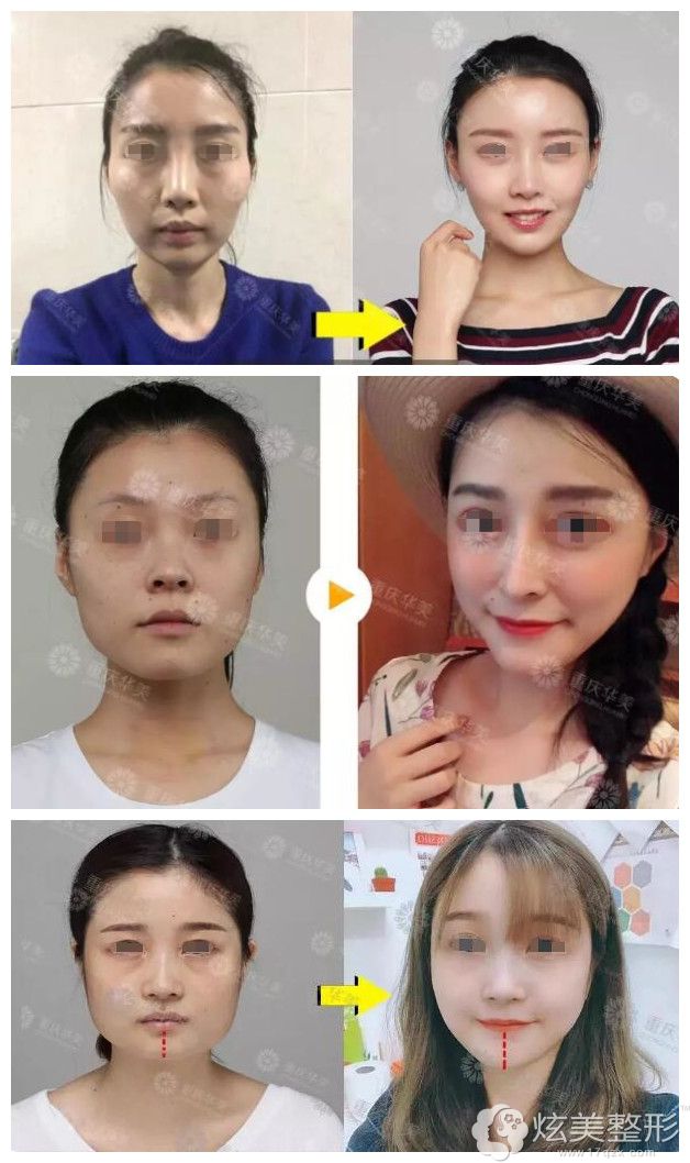 重庆华美磨骨案例 重庆华美磨骨案例