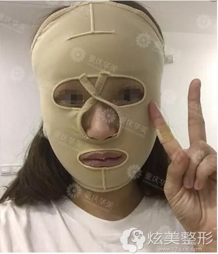 刚做完磨骨手术佩戴头套 刚做完磨骨手术佩戴头套