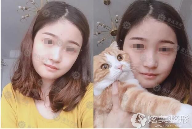 术后半个月磨骨恢复中 术后半个月磨骨恢复中