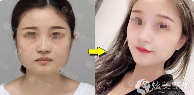 在重庆华美做磨骨整形案例 在重庆华美做磨骨整形案例