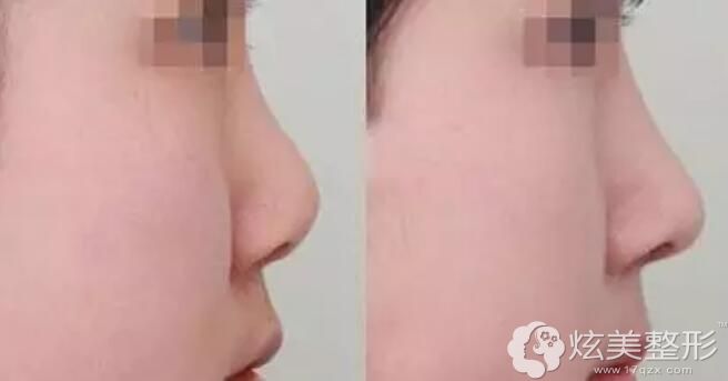 程相化隆鼻案例 程相化隆鼻案例