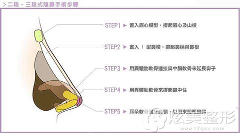江主任三段式隆鼻简易手术步骤 江主任三段式隆鼻简易手术步骤
