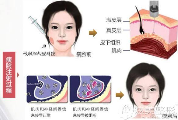重庆时光整形瘦脸图解 重庆时光整形瘦脸图解