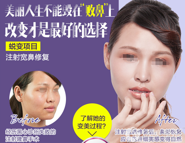 注射宽鼻修复案例 注射宽鼻修复案例
