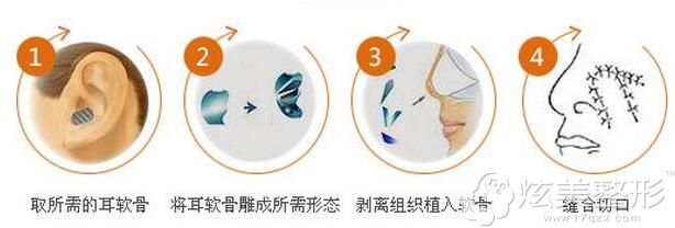 自体耳软骨垫鼻头 自体耳软骨垫鼻头