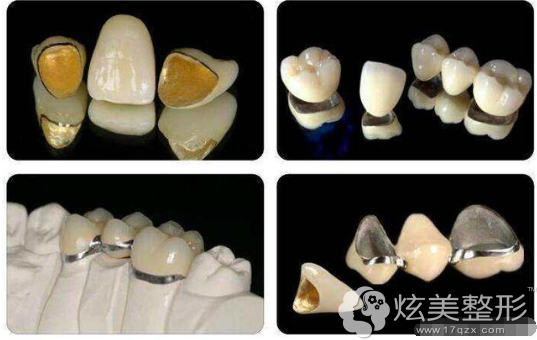 不同材质的烤瓷牙价格不同 不同材质的烤瓷牙价格不同