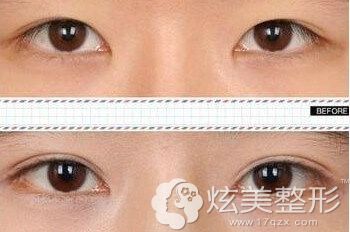 开内眼角手术后真实案例 开内眼角手术后真实案例