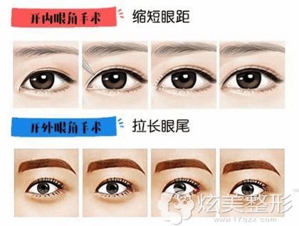 开内眼角和外眼角分别可以达到的术后效果 开内眼角和外眼角分别可以达到的术后效果