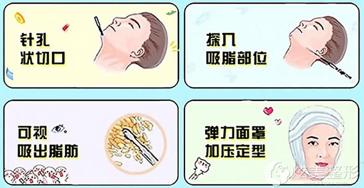 面部吸脂手术原理 面部吸脂手术原理