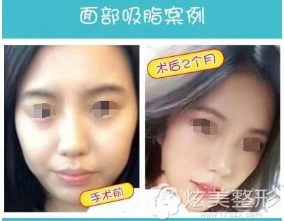 开封艺美面部吸脂案例 开封艺美面部吸脂案例