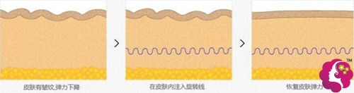 万友望主任做埋线提升原理 万友望主任做埋线提升原理