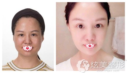 广州曙光整形主任万友望做埋线提升案例 广州曙光整形主任万友望做埋线提升案例