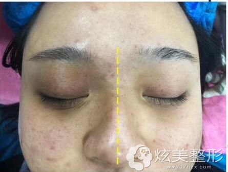 熊猫针去黑眼圈做一半对比治疗