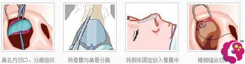 袁林医生做假体隆鼻手术过程 袁林医生做假体隆鼻手术过程