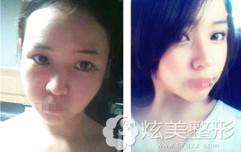 东莞禾美袁林医生假体隆鼻案例 东莞禾美袁林医生假体隆鼻案例