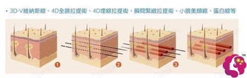 北京上上相做埋线提升除皱过程 北京上上相做埋线提升除皱过程