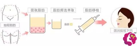 彭永东主任的特色项目自体脂肪丰下巴 彭永东主任的特色项目自体脂肪丰下巴