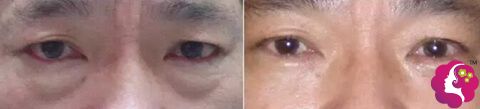 李鸿儒主任不开刀去眼袋手术前后对比 李鸿儒主任不开刀去眼袋手术前后对比