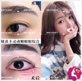 昆明婕熹卡眼综合案例 昆明婕熹卡眼综合案例