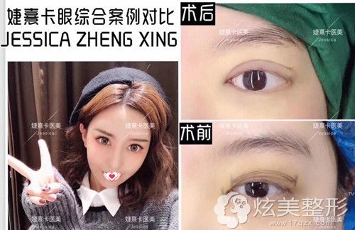 婕熹卡整形医院做眼综合前后对比 婕熹卡整形医院做眼综合前后对比