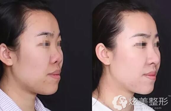 蒙石南隆鼻失败修复案例 蒙石南隆鼻失败修复案例