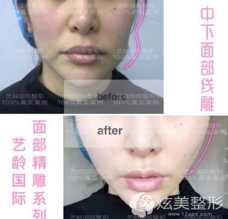 张志成医生线雕提升案例 张志成医生线雕提升案例