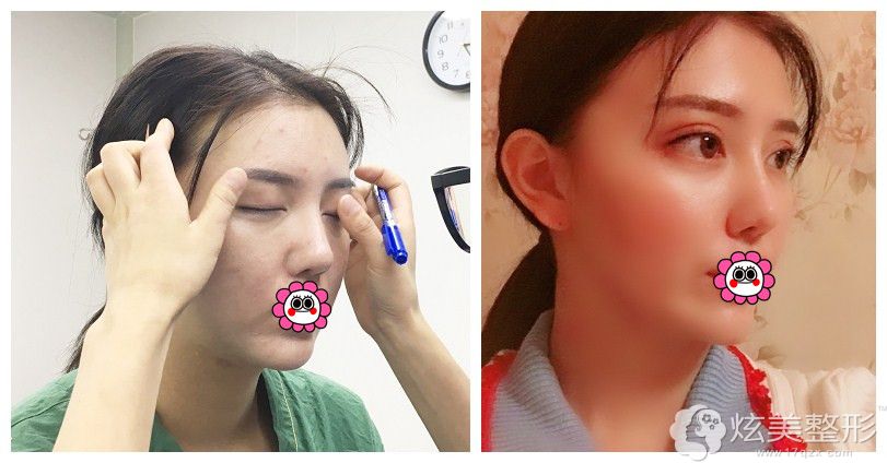 赵章杰院长双眼皮手术案例 赵章杰院长双眼皮手术案例