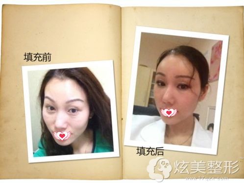 赵春飞医生做脂肪填充后面部饱满立体 赵春飞医生做脂肪填充后面部饱满立体