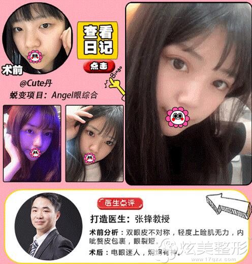 张峰芭比眼手术案例一 张峰芭比眼手术案例一
