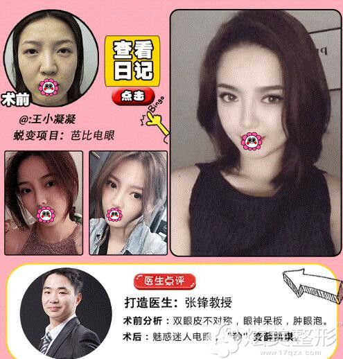 张峰芭比眼手术案例二 张峰芭比眼手术案例二