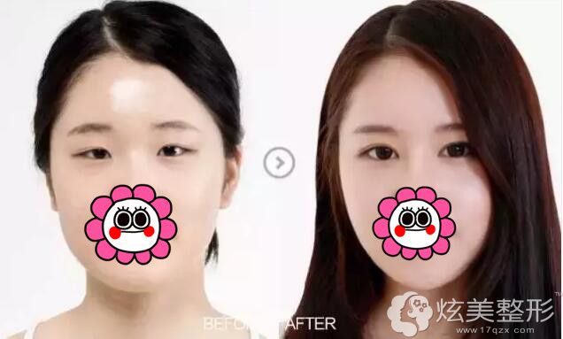 上眼皮处脂肪特别重的肿泡眼做双眼皮对比案例