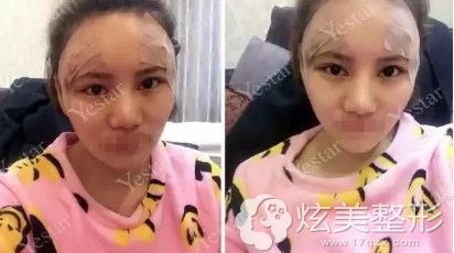 在温州艺星刚做完脂肪填充面部后有点肿胀 在温州艺星刚做完脂肪填充面部后有点肿胀