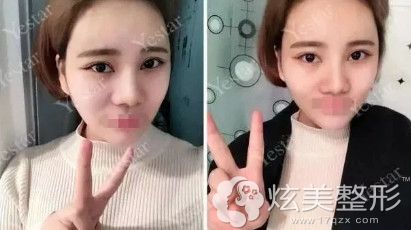 成浩医生为我做脂肪填充面部术后8天肿胀消除 成浩医生为我做脂肪填充面部术后8天肿胀消除