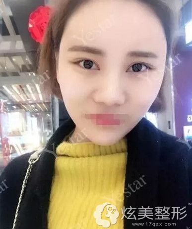 在温州艺星做面部填充术后20天恢复自然 在温州艺星做面部填充术后20天恢复自然