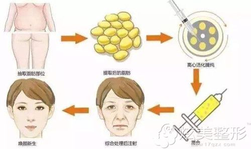 华美采用自体脂肪除皱术原理 华美采用自体脂肪除皱术原理