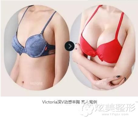 在刘光伟那里做了娜琦丽假体隆胸,实现了从A到C的完美蜕变 在刘光伟那里做了娜琦丽假体隆胸,实现了从A到C的完美蜕变