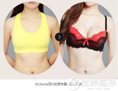 南京维多利亚的Victoria丰胸术,让我把输掉的性感赢了回来 南京维多利亚的Victoria丰胸术,让我把输掉的性感赢了回来