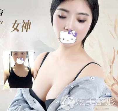 重庆艺星金辉医生那里做等U2弹性丰胸术 重庆艺星金辉医生那里做等U2弹性丰胸术