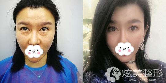 杨文国主任做外切去眼袋术后恢复效果 杨文国主任做外切去眼袋术后恢复效果