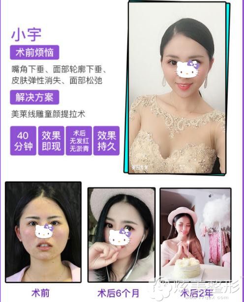 郭江花医生的埋线提拉真人术后效果图 郭江花医生的埋线提拉真人术后效果图