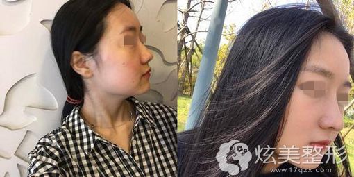 龙海波院长假体隆鼻术前术后真人案例对比 龙海波院长假体隆鼻术前术后真人案例对比
