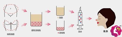 龙院长介绍自体脂肪隆鼻的手术步骤 龙院长介绍自体脂肪隆鼻的手术步骤